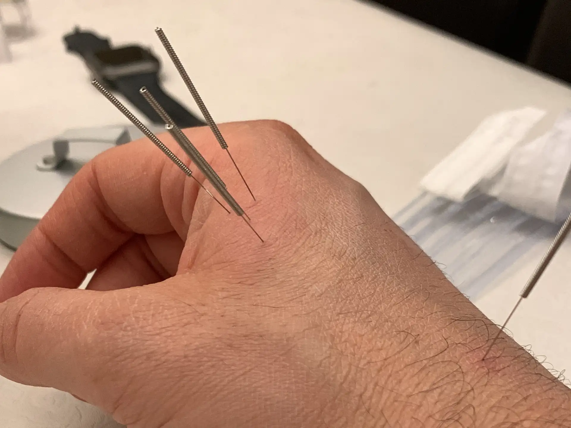full function rehab and wellness clinic woodbridge vaughn on meidcal acupuncture 1