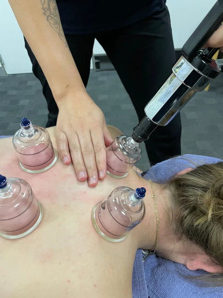 what is cupping therapy rotated